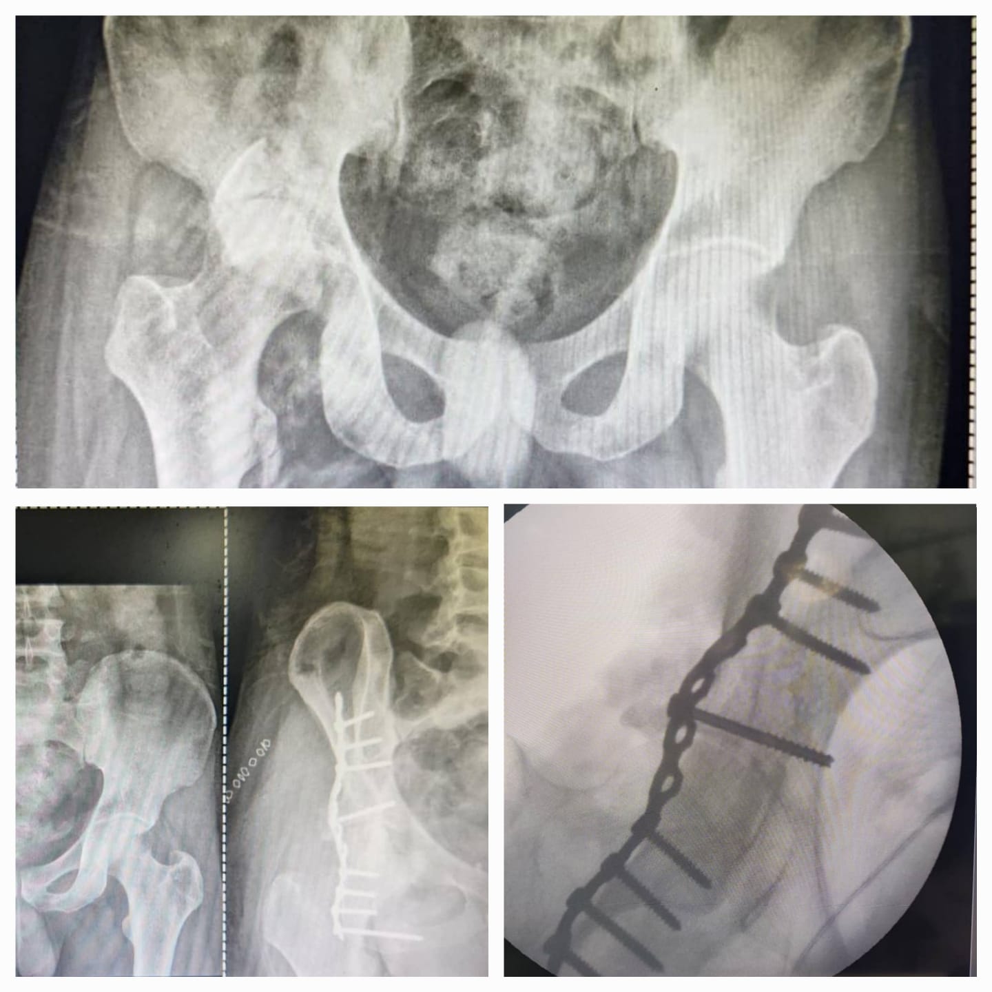 PELVI ARCTABULAR FRACTURE FIXATION